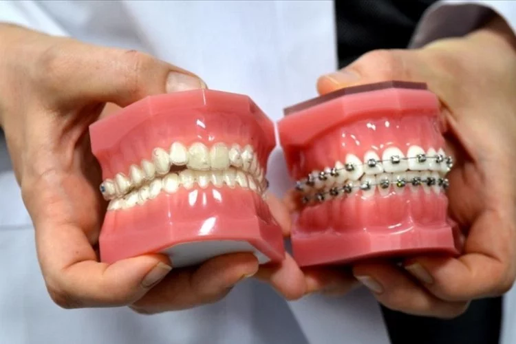 Diş Teline Avantajlı :alternatif Şeffaf Plaklar