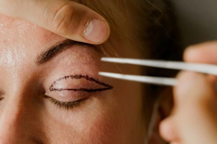 Göz Kapağı Estetiği Ameliyatı Nasıl Yapılır?